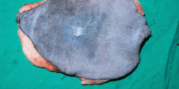 - photo 1: la résection d’un fibrosarcome sous entend une chirurgie « large » et donc fréquemment, une reconstruction comme dans ce cas avec un lambeau de grand dorsal