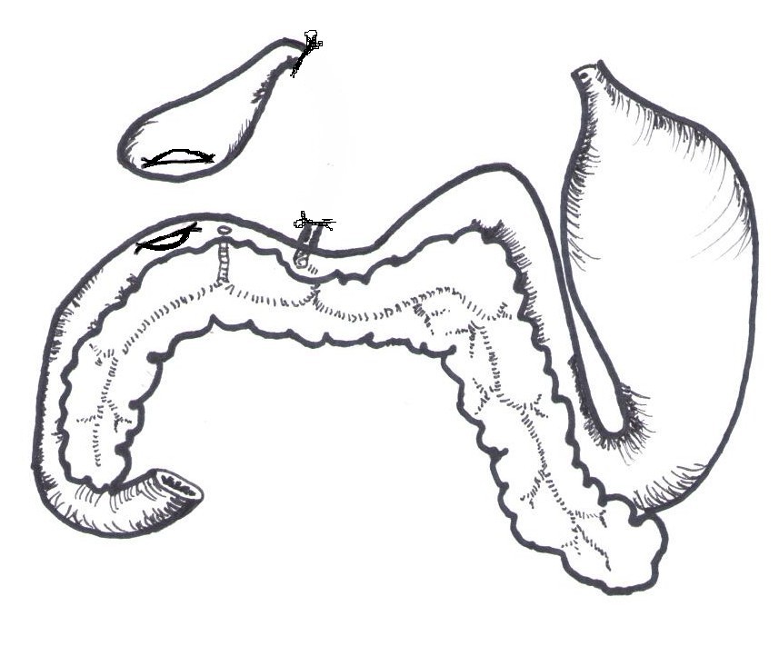 Figure 2 d’après (2,7) Anatomie simplifiée ligature et section de la partie lésée du cholédoque  et abouchement des ostiums créés dans la vésicule biliaire et le duodénum.